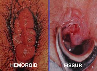 hemoroid fissuer